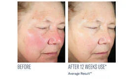 Even Tone Intensive