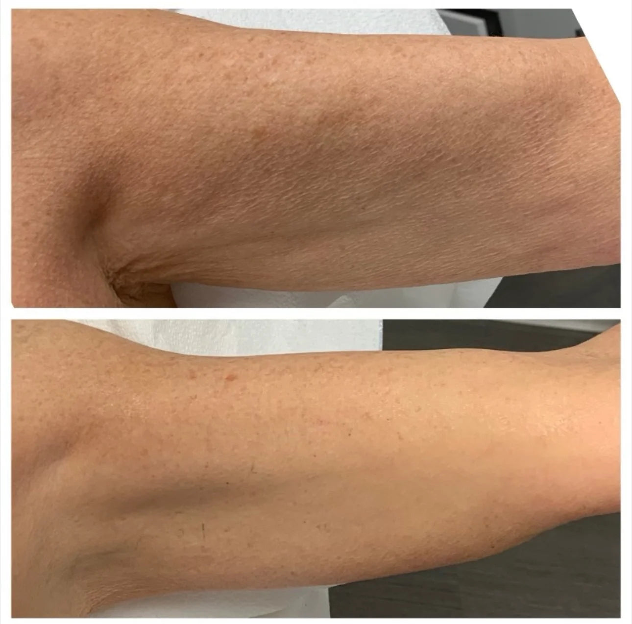Epicutis Lipid Body Treatment