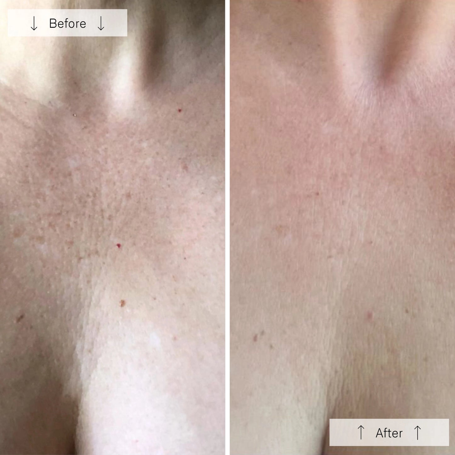Omnilux Contour Neck & Decollete